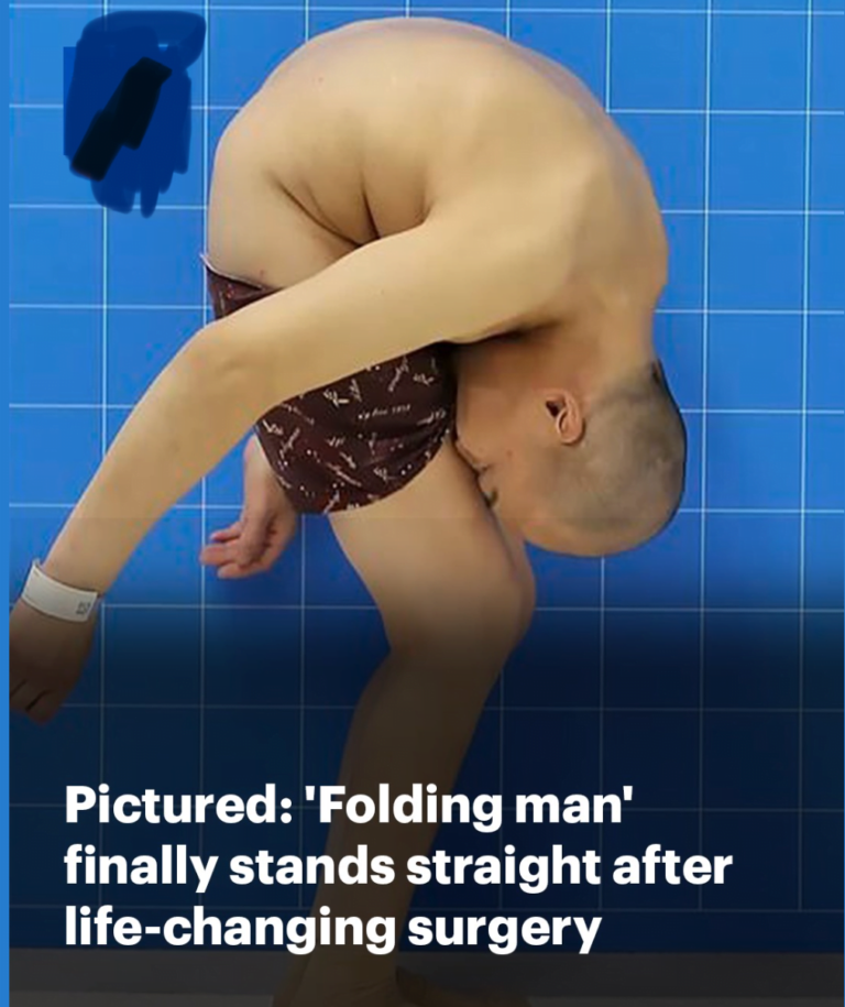 Folding Man Li Hua, 46 Can Finally Stand Straight After Life-Changing Surgery Folding Man Li Hua, 46 Can Finally Stand Straight After Life-Changing Surgery