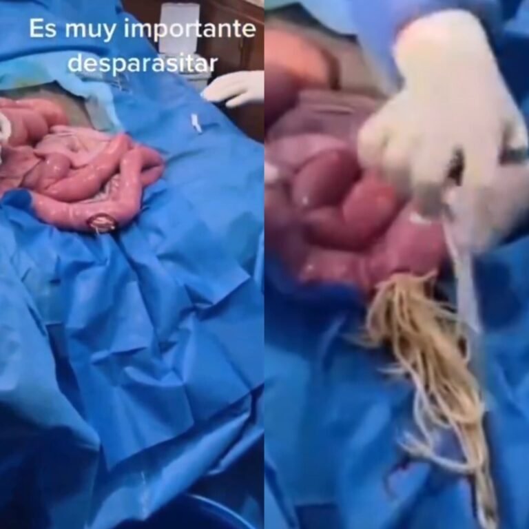 Deworming Video: Doctors Remove Hundreds Of Parasitic Worms From Human Intestine Deworming Video: Doctors Remove Hundreds Of Parasitic Worms From Human Intestine